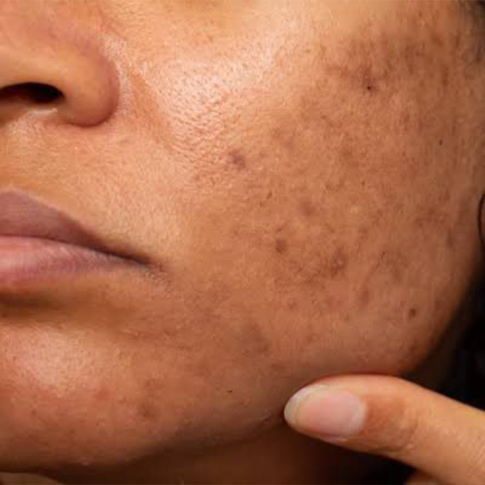 Hyperpigmentation