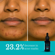 Blemish Balance Serum | Reduces Hyperpigmentation and Acne Marks