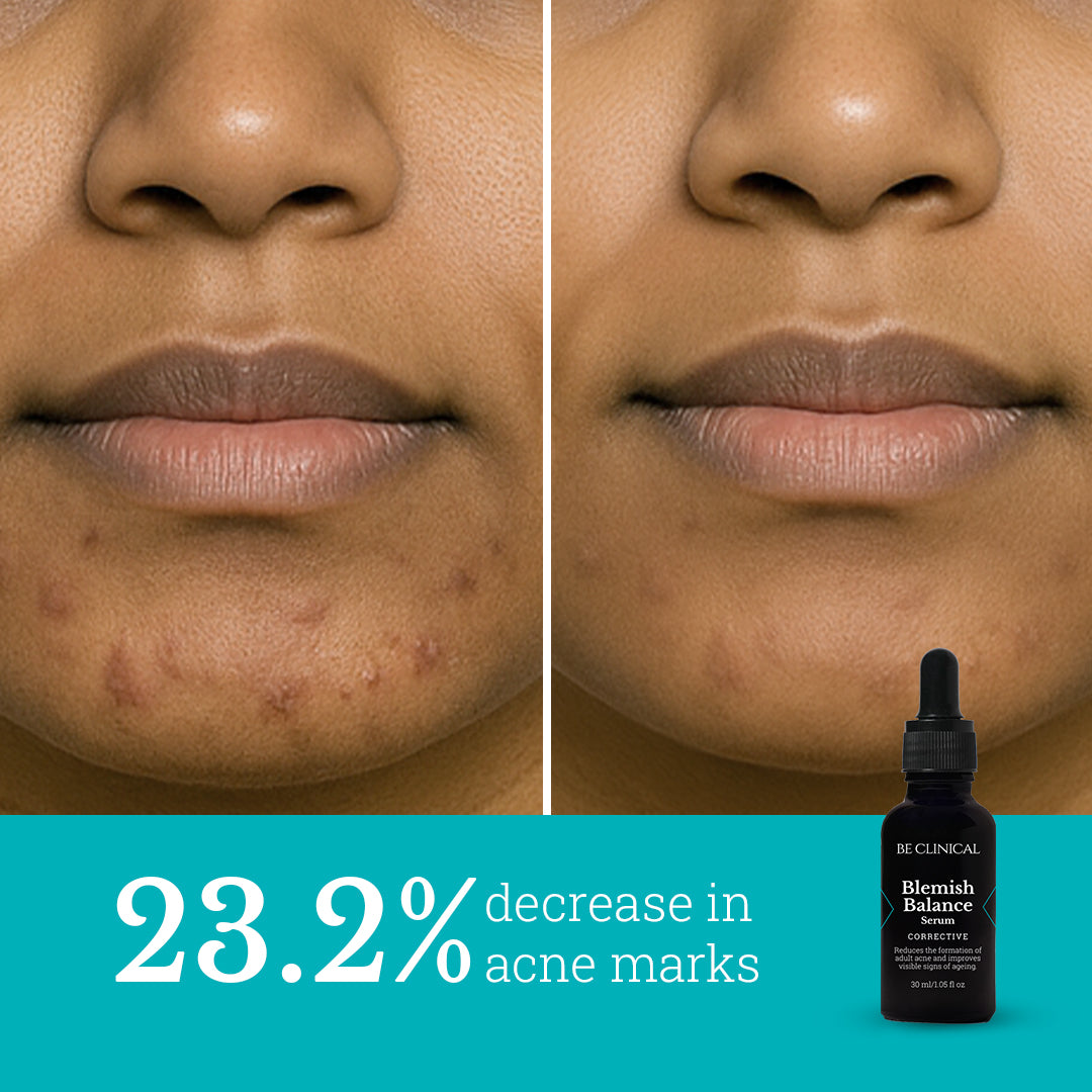 Blemish Balance Serum | For Menopausal Skin