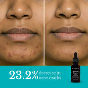 Blemish Balance Serum | For Menopausal Skin