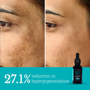 Blemish Balance Serum | Reduces Hyperpigmentation and Acne Marks