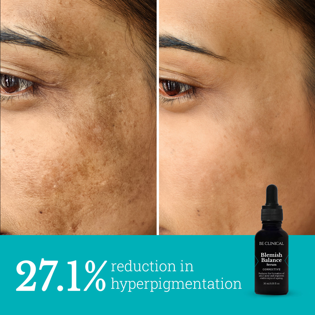 Blemish Balance Serum | For Menopausal Skin